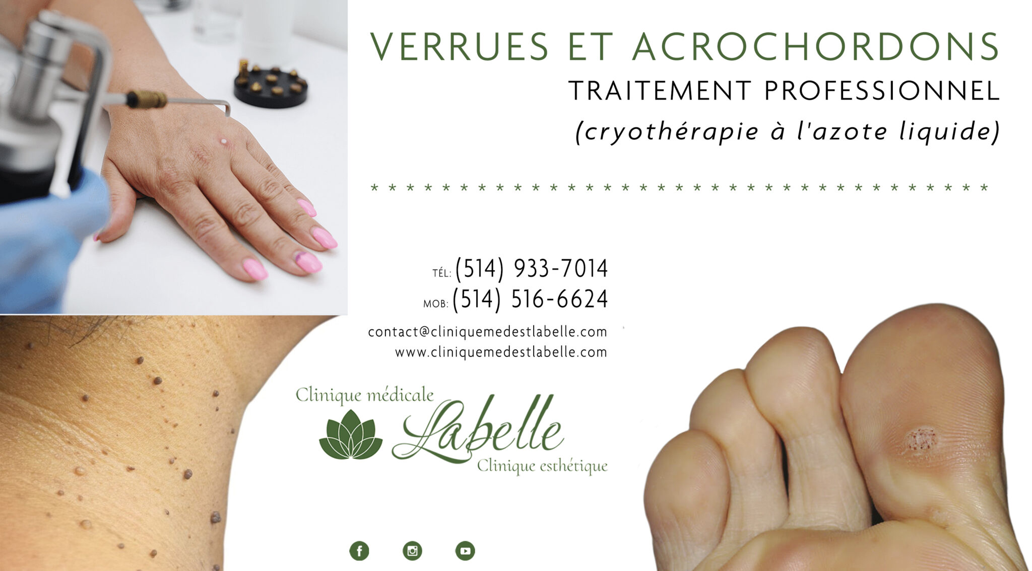 Verrues et acrochordons - traitement professionnel (cryothérapie à l