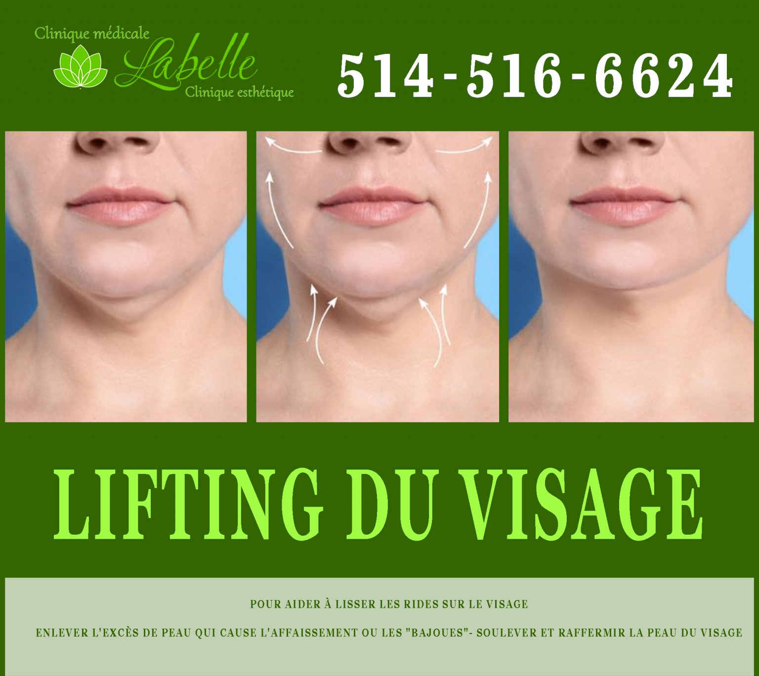 Comment Fonctionne Un LIFTING DU VISAGE comment-fonctionne-un-lifting-du-visage