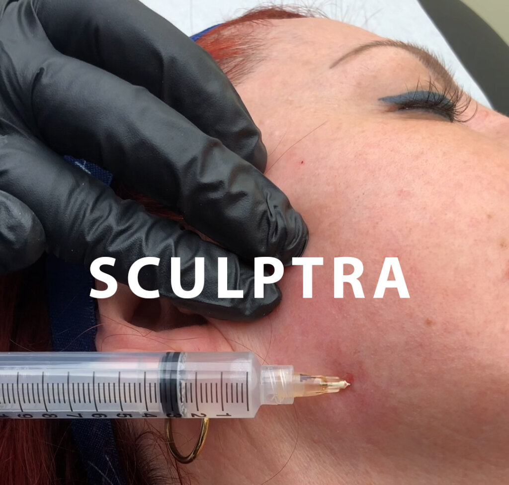 Comment fonctionne Sculptra?