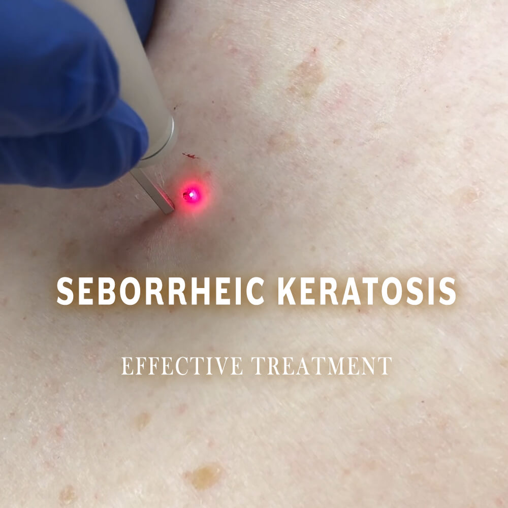 SEBORRHEIC KERATOSIS - THE BEST CO2 LASER TREATMENT!