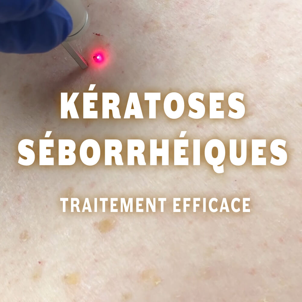 KÉRATOSES SÉBORRHÉIQUES - traitement efficace