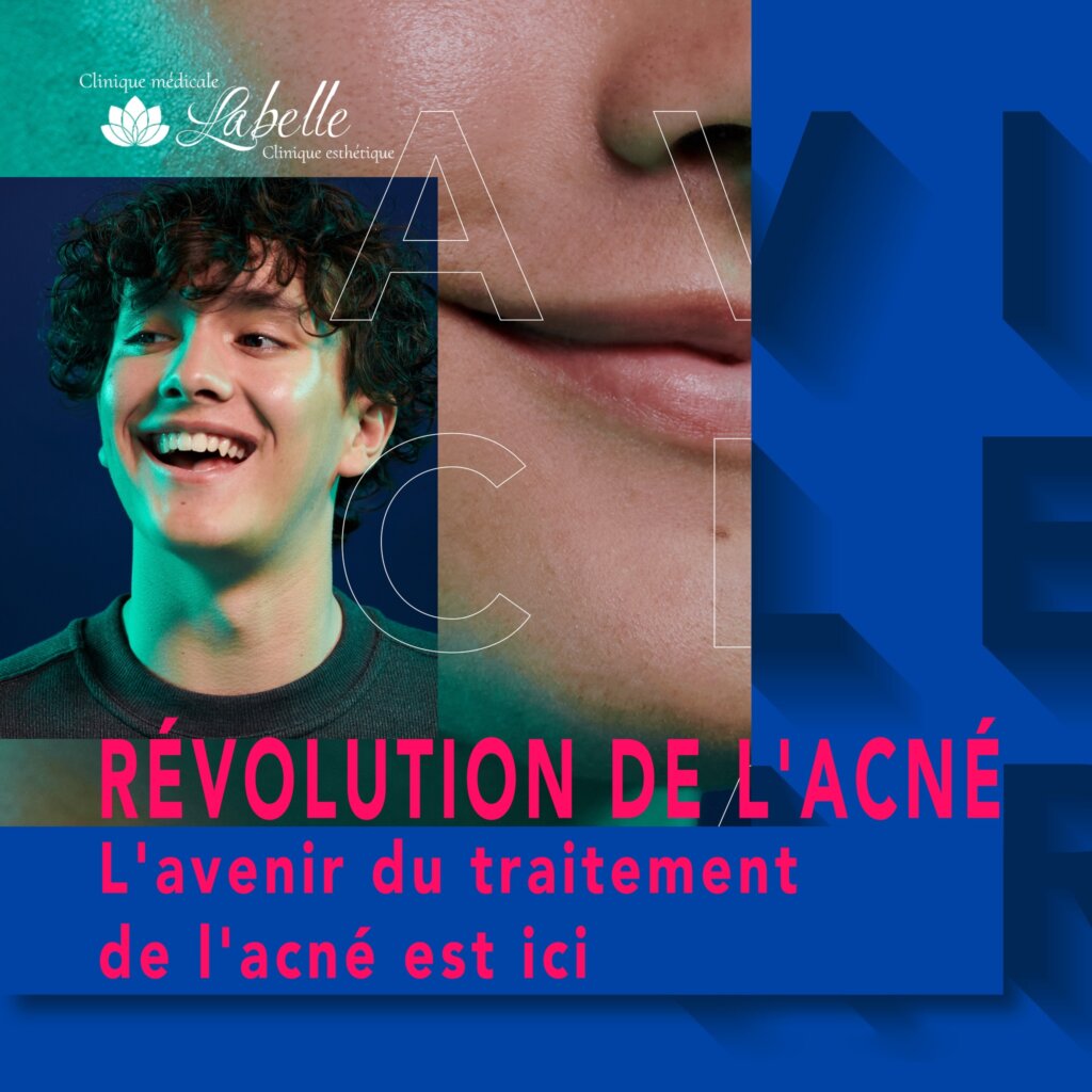 LE MEILLEUR TRAITEMENT AU LASER POUR L'ACNÉ