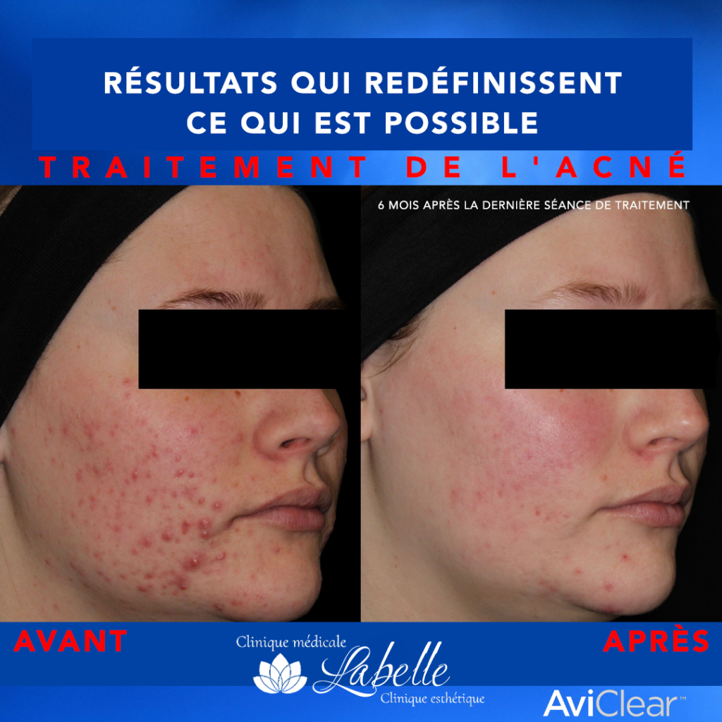 Traitement révolutionnaire rapide et efficace de traiter l'acné
