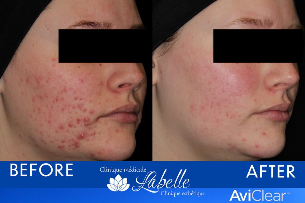 Revolutionary, fast and effective treatment to treat acne