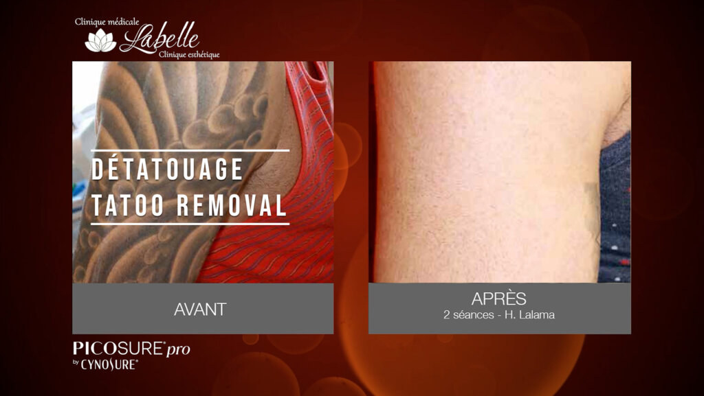 DÉTATOUAGE AVEC LE LASER PicoSure Pro À LAVAL ET DANS LA GRANDE RÉGION DE MONTRÉAL – TATTOO REMOVAL WITH THE PicoSure Pro LASER IN LAVAL AND GREATER MONTREAL