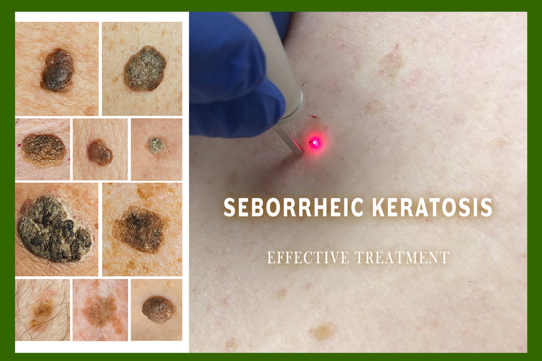 Seborrheic Keratosis Removal Treatment in Laval and Greater Montreal Area – Causes, Risks and Painless Treatments - CO2 Laser Treatment at LABELLE Clinic - honest testimony - Seborrheic Keratosis With Cryotherapy