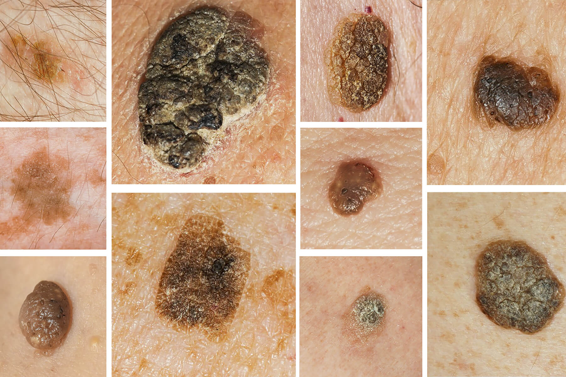 Seborrheic Keratosis Removal Treatment in Laval and Greater Montreal Area – Causes, Risks and Painless Treatments - CO2 Laser Treatment at LABELLE Clinic - honest testimony - Seborrheic Keratosis With Cryotherapy