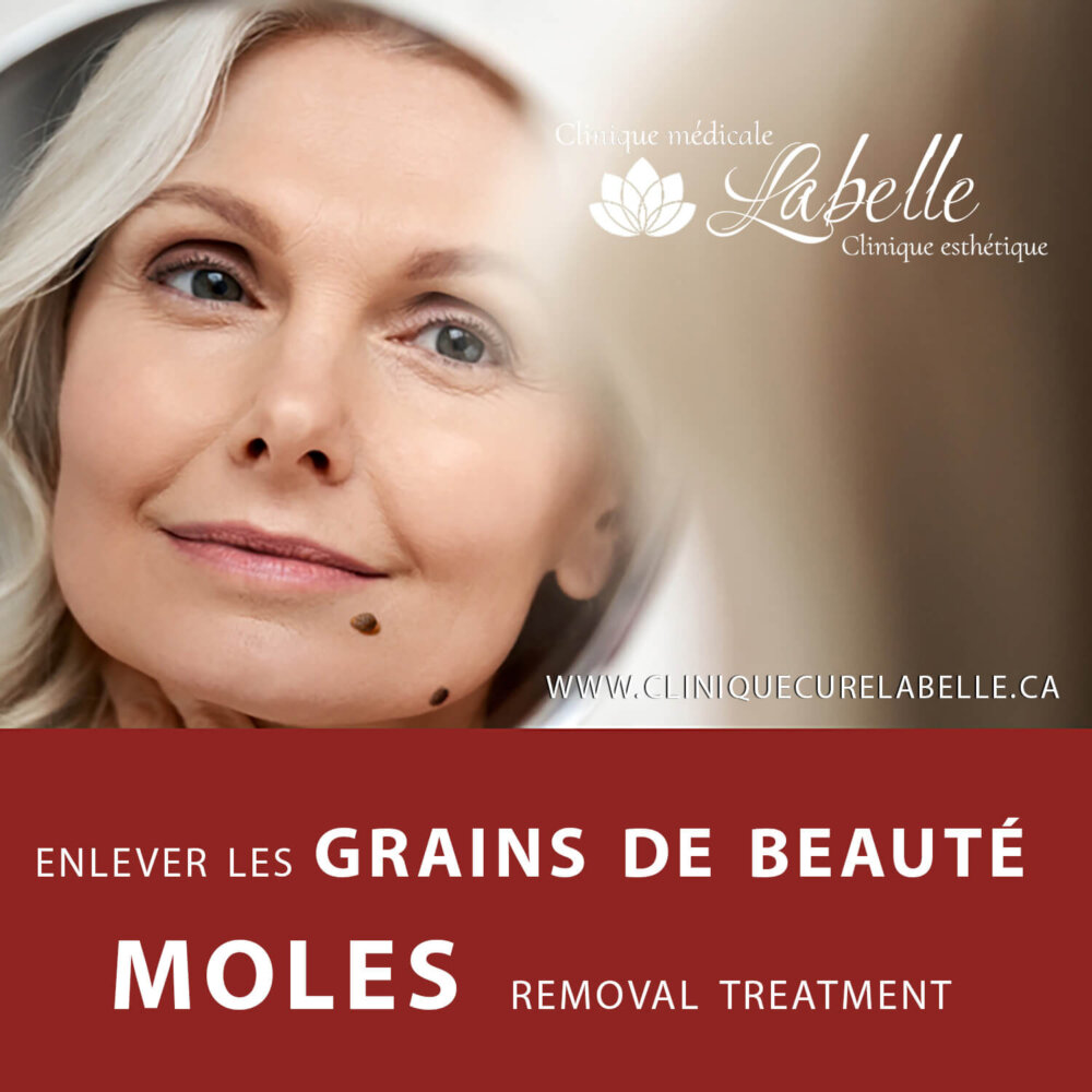 Grains de beauté-naevus – Traitement à Laval et dans la grande région de Montréal. Avantages du laser CO2. Le diagnostic avant le traitement des grains de beauté avec le laser CO2. Procédure de traitement des grains de beauté avec Laser co2. Le coût du traitement pour l'élimination des grains de beauté