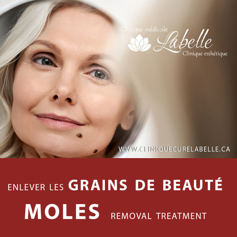 Moles - nevus – Treatment in Laval and the greater Montreal area - The cost of treatment - make an appointment with a professional - Areas where moles appear - Remove moles with CO2 laser - Advantages of the CO2 laser in the treatment of moles removal o