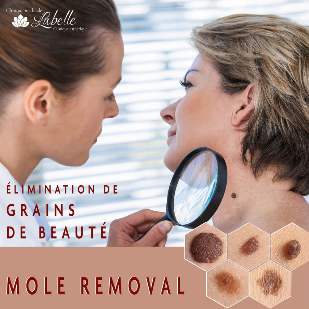 Moles - nevus – Treatment in Laval and the greater Montreal area - The cost of treatment - make an appointment with a professional - Areas where moles appear - Remove moles with CO2 laser - Advantages of the CO2 laser in the treatment of moles removal of moles - The diagnosis - How to have a mole removed with a CO2 laser - Get rid of moles today - Have you managed to get rid of moles with our specialists - Some advice on moles care after treatment - Contraindications - When to call the doctor - The specialists in our clinic are always available - can they be eliminated permanently