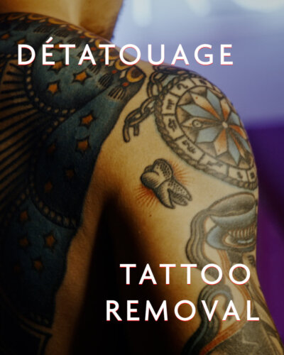 Tattoo removal with the Picosure Pro laser in Laval and the greater Montreal area. Price of tattoo removal treatment with Laser PicoSure Pro