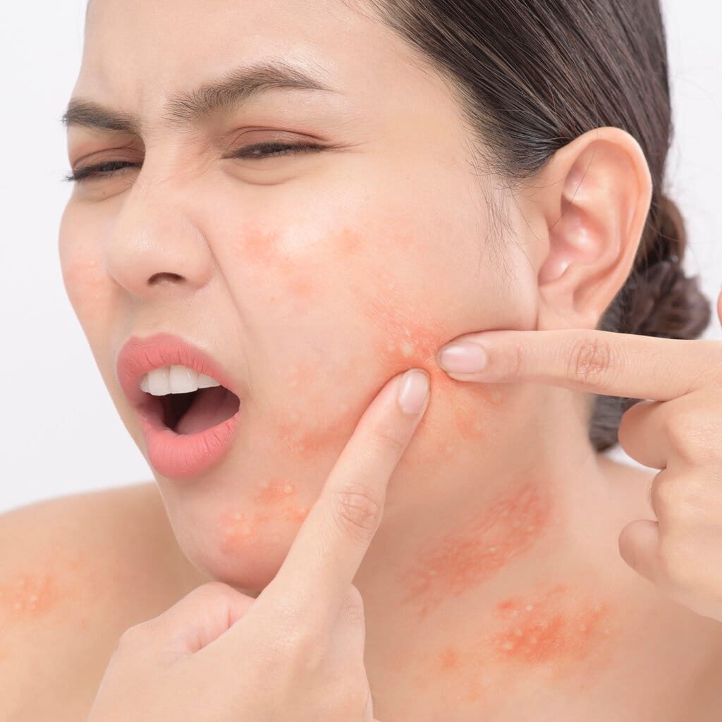 Acne Treatment - mild to severe acne - Laval and Montreal area