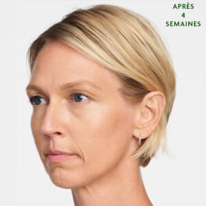 Sculptra est un traitement esthétique injectable à Laval et la région de Montréal conçu pour remplir des zones spécifiques du corpss. Il favorise la production de comblement naturel dans votre corps, permettant de combler les rides sur le long terme et d'aider votre peau à générer du nouveau collagène.