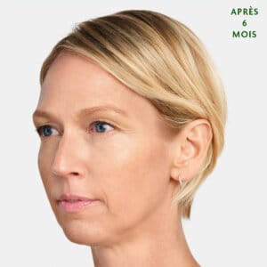 Sculptra est un traitement esthétique injectable à Laval et la région de Montréal conçu pour remplir des zones spécifiques du corpss. Il favorise la production de comblement naturel dans votre corps, permettant de combler les rides sur le long terme et d'aider votre peau à générer du nouveau collagène.