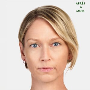 Sculptra est un traitement esthétique injectable à Laval et la région de Montréal conçu pour remplir des zones spécifiques du corpss. Il favorise la production de collagène naturel dans votre corps, permettant de combler les rides sur le long terme et d'aider votre peau à générer du nouveau collagène.