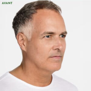 Rajeunissement avec Radiesse. Cinq raisons pour lesquelles vous pourriez envisager d'utiliser l’injections biostimulateur Radiesse