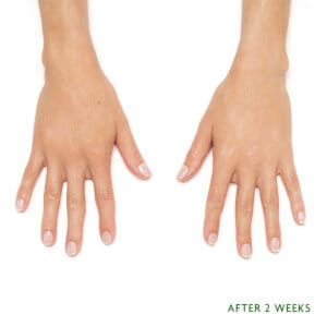 Injectable aesthetic treatment in Laval and the Montreal area designed to fill specific areas of the body. Fill wrinkles over the long term. Rejuvenation with Radiesse.