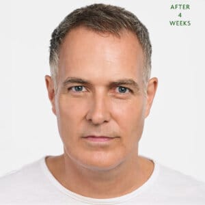 Rejuvenation with Radiesse. Five reasons why you might consider using Radiesse injections as Collagen biostimulators.