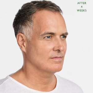 Rejuvenation with Radiesse. Five reasons why you might consider using Radiesse injections as Collagen biostimulators.