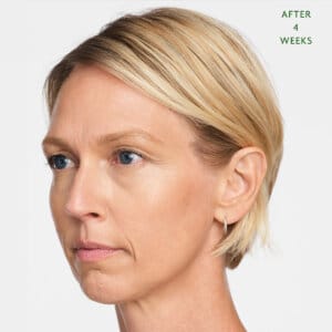 Sculptra is an injectable aesthetic treatment in Laval and the Montreal area designed to fill specific areas of the body. It promotes the production of natural fillers in your body. It is effective in reducing deep wrinkles and folds, such as nasolabial folds (smile lines) and marionette lines. Radiesse gradually improves skin texture and firmness.