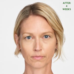 Sculptra is an injectable aesthetic treatment in Laval and the Montreal area designed to fill specific areas of the body. It promotes the production of natural fillers in your body. It is effective in reducing deep wrinkles and folds, such as nasolabial folds (smile lines) and marionette lines. Radiesse gradually improves skin texture and firmness.