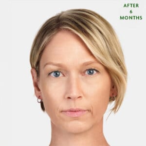 Sculptra is an injectable aesthetic treatment in Laval and the Montreal area designed to fill specific areas of the body. It promotes the production of natural fillers in your body. It is effective in reducing deep wrinkles and folds, such as nasolabial folds (smile lines) and marionette lines. Radiesse gradually improves skin texture and firmness.