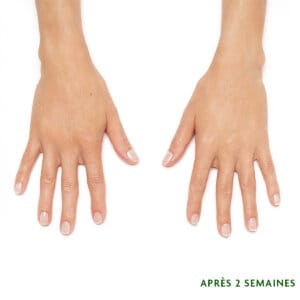 Traitement esthétique injectable à Laval et la région de Montréal conçu pour remplir des zones spécifiques du corps. Combler les rides sur le long terme. Rajeunissement avec Radiesse.