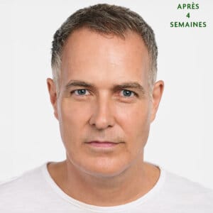 Rajeunissement avec Radiesse. Cinq raisons pour lesquelles vous pourriez envisager d'utiliser l’injections Radiesse