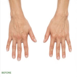 Injectable aesthetic treatment in Laval and the Montreal area designed to fill specific areas of the body. Fill wrinkles over the long term. Rejuvenation with Radiesse.