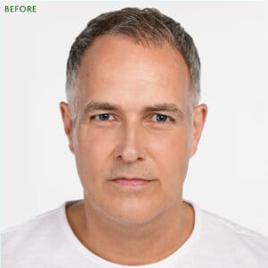 Rejuvenation with Radiesse. Five reasons why you might consider using Radiesse biostimulator injections.