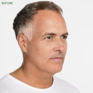 Rejuvenation with Radiesse. Five reasons why you might consider using Radiesse injections as Collagen biostimulators.