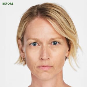 Sculptra is an injectable aesthetic treatment in Laval and the Montreal area designed to fill specific areas of the body. It promotes the production of natural fillers in your body. It is effective in reducing deep wrinkles and folds, such as nasolabial folds (smile lines) and marionette lines. Radiesse gradually improves skin texture and firmness.