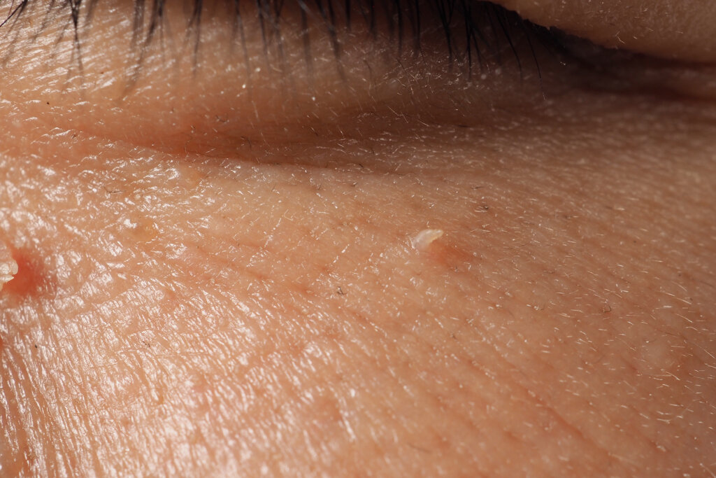 Skin tags causing irritation or discomfort? Do the skin tags affect your appearance? Skin tags infected or bleeding? Do the skin tags interfere with your daily activities?