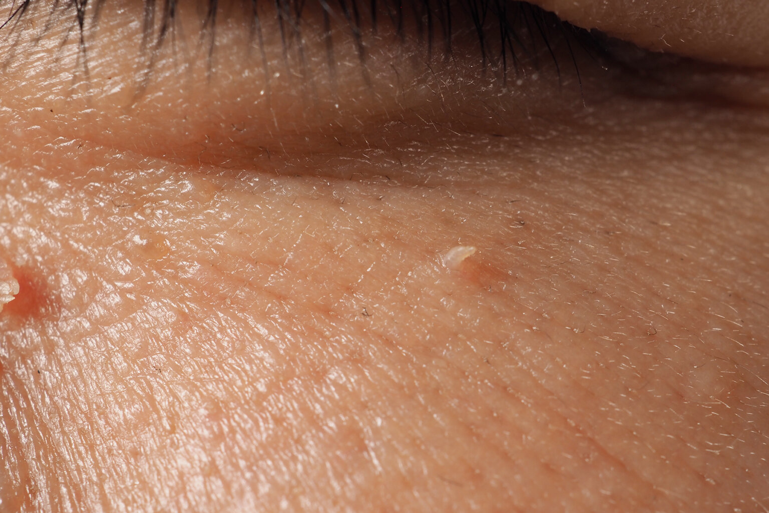 Skin tags causing irritation or discomfort? Do the skin tags affect your appearance? Skin tags infected or bleeding? Do the skin tags interfere with your daily activities?