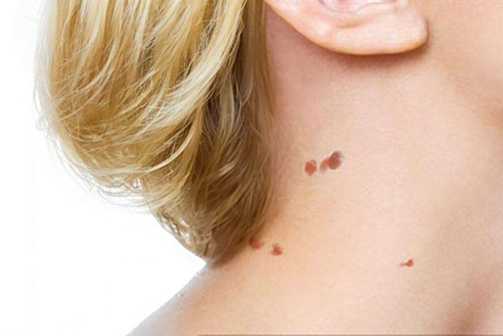 Skin tags causing irritation or discomfort? Do the skin tags affect your appearance? Skin tags infected or bleeding? Do the skin tags interfere with your daily activities?