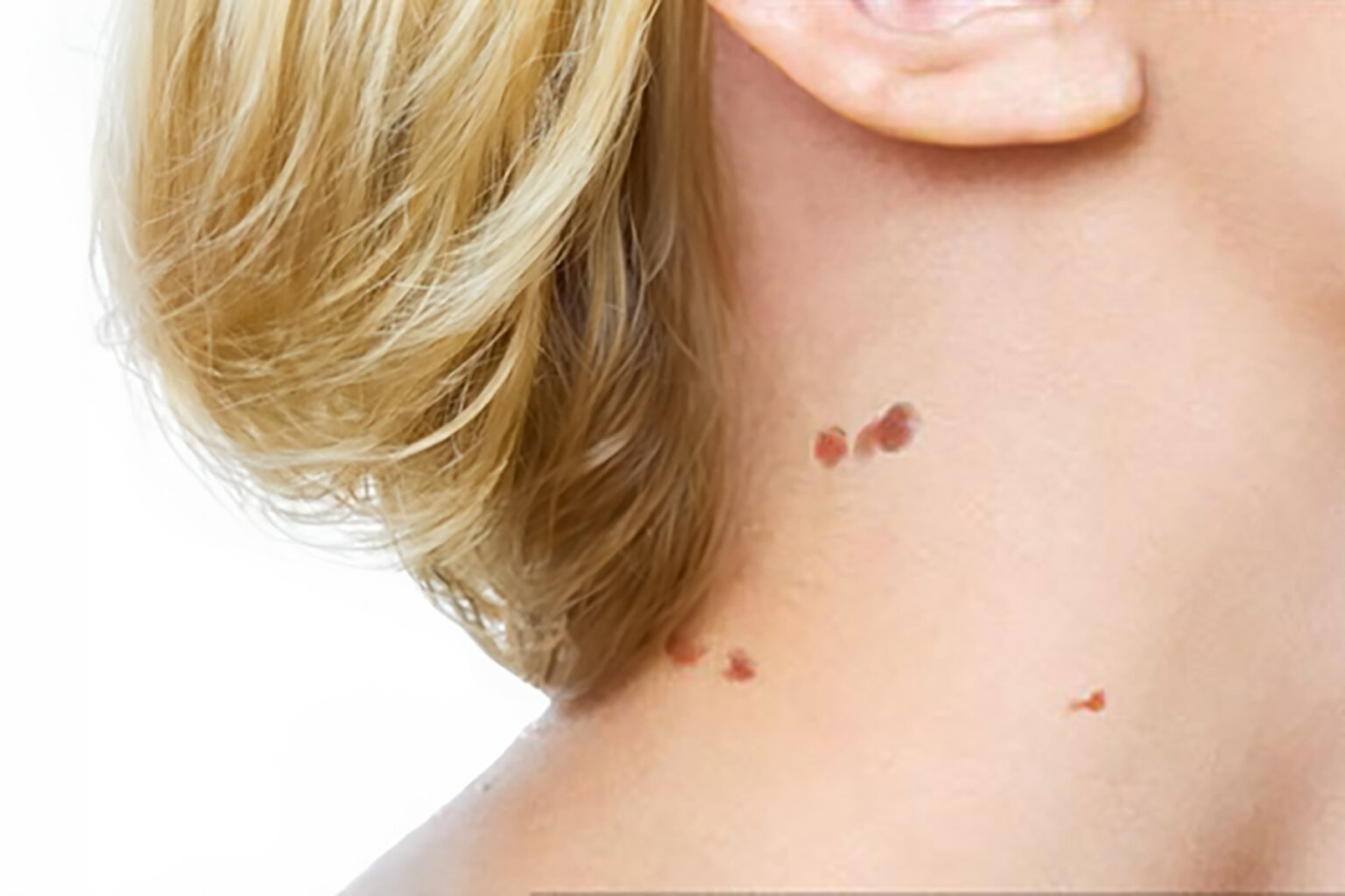 Skin tags causing irritation or discomfort? Do the skin tags affect your appearance? Skin tags infected or bleeding? Do the skin tags interfere with your daily activities?