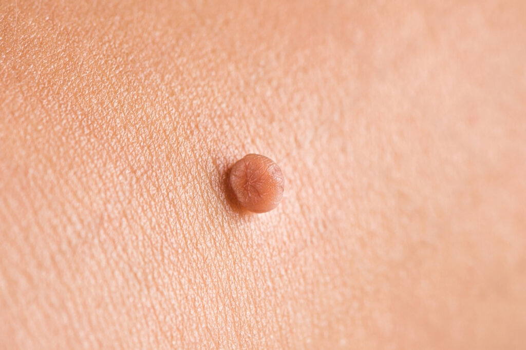 Skin tags causing irritation or discomfort? Do the skin tags affect your appearance? Skin tags infected or bleeding? Do the skin tags interfere with your daily activities?