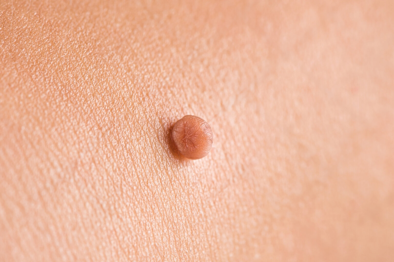 Skin tags causing irritation or discomfort? Do the skin tags affect your appearance? Skin tags infected or bleeding? Do the skin tags interfere with your daily activities?