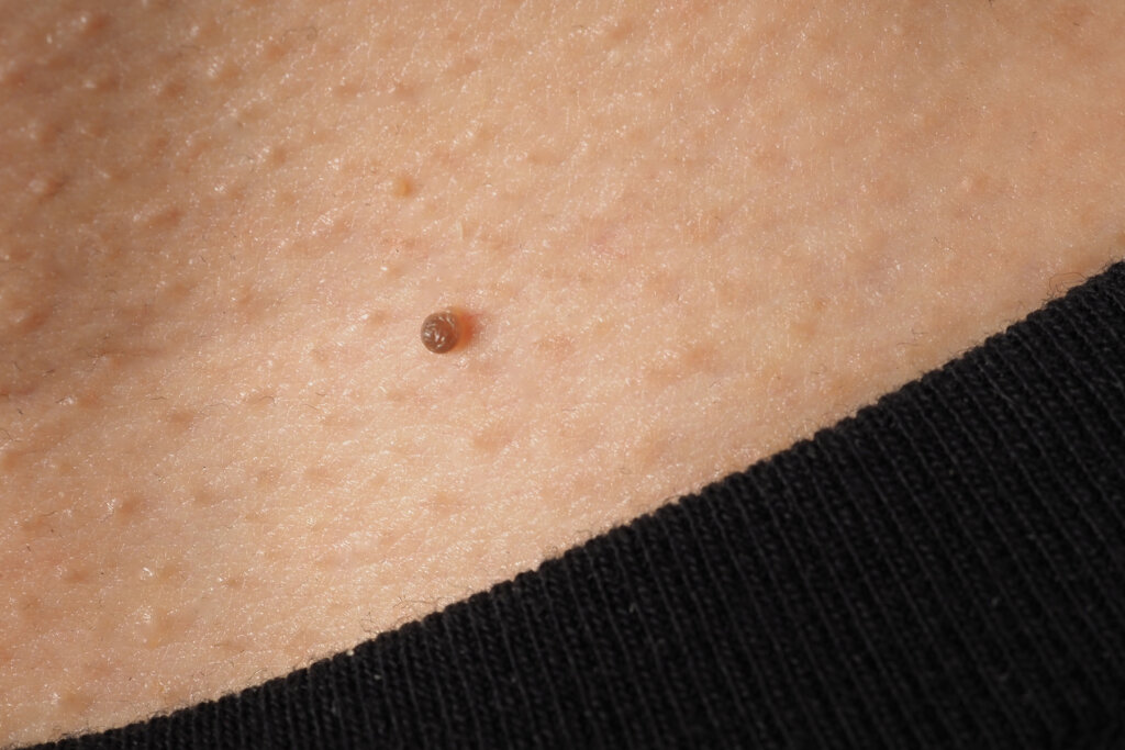 Skin tags removal specialist-best specialist for skin tags removal-laser treatment for skin tags-skin tags removal cryotherapy-skin tags removal with azote liquid-skin tags removal with azote