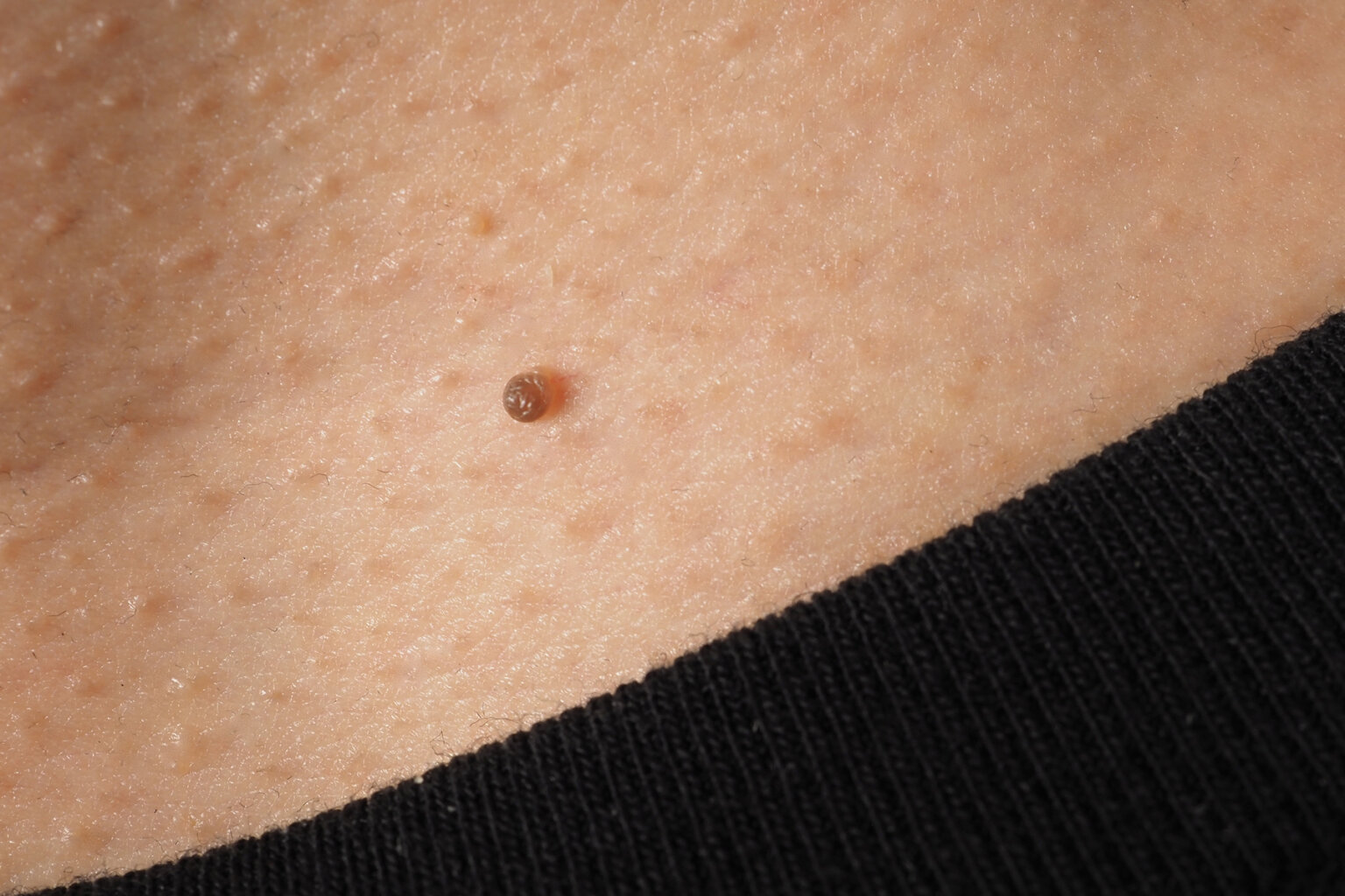 Skin tags removal specialist-best specialist for skin tags removal-laser treatment for skin tags-skin tags removal cryotherapy-skin tags removal with azote liquid-skin tags removal with azote